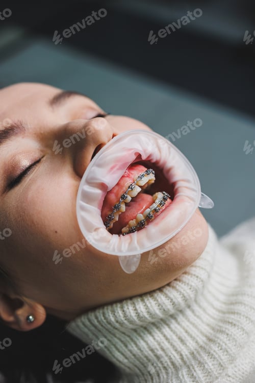Preview: Oral care. Bracket system on women's teeth. Installation of braces to align teeth.