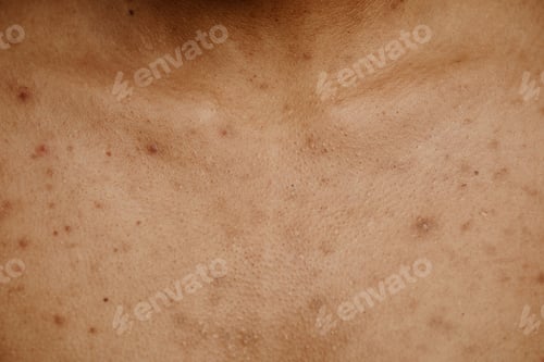 Preview: Macro shot of tan skin with acne scar spots and texture