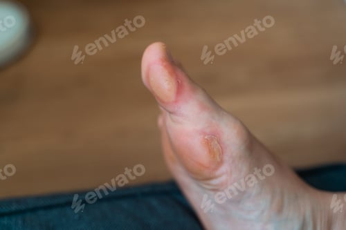 Preview: Close-up of a soft callus on a foot of a woman, sport shoes problem, corn on the leg. blister on the