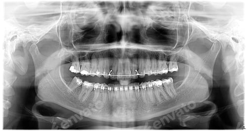 Preview: X-ray of a skull. Mouth and teeth with braces. Orthodontics and dental imagery