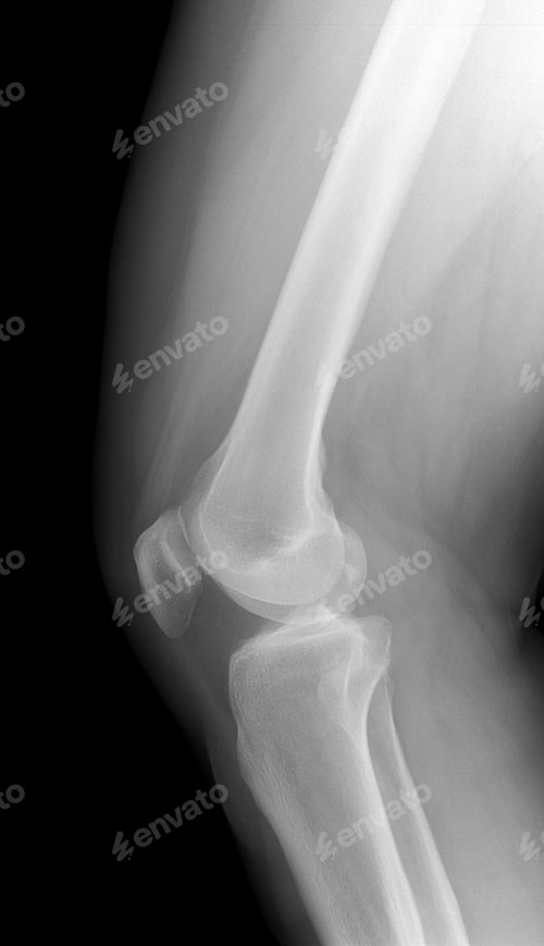 Preview: Vertical shot of a knee and leg x-ray