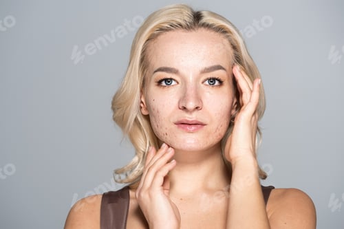 Preview: Portrait of blonde model with skin issue touching face isolated on grey