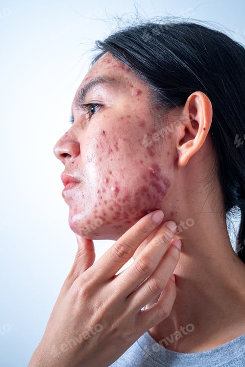 Preview: Acne on face because the disorders of sebaceous glands productions. Acne or a Cosmetic