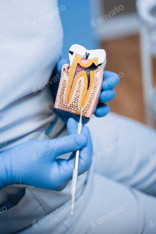 Preview: Educational tooth model with decay shown by professional dentist