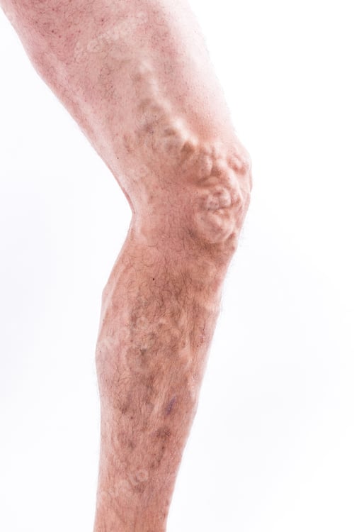 Preview: People with varicose veins of the lower extremities and venous t