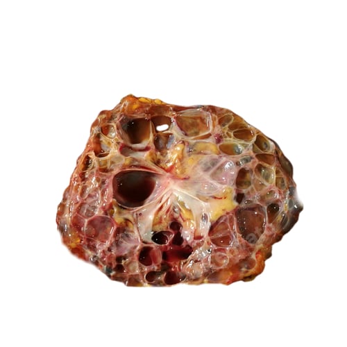 Preview: Polycystic kidney disease