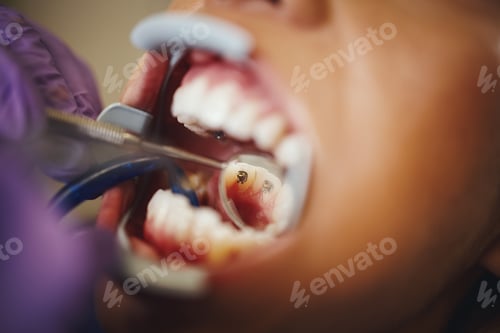 Preview: Lingual Braces Checkup