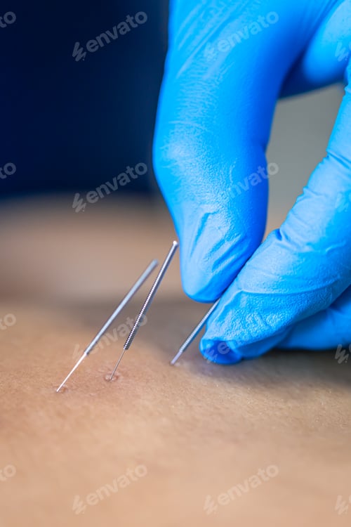 Preview: Close up of a needle and hands of physiotherapist doing a dry needling.
