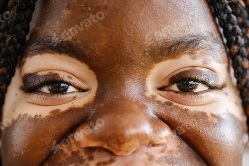 Preview: Close-up view shot of young adult african woman eyes with vitiligo