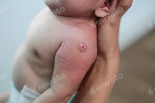 Preview: Newborn baby with red spots due to injection