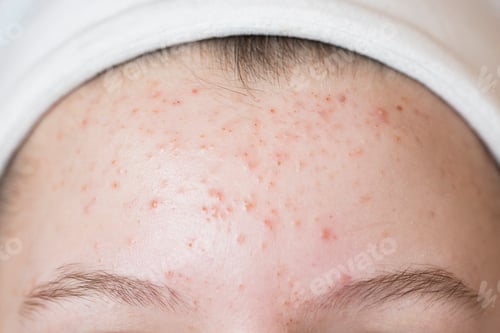 Preview: Problematic skin. Acne and red festering pimples on the face of a young girl .