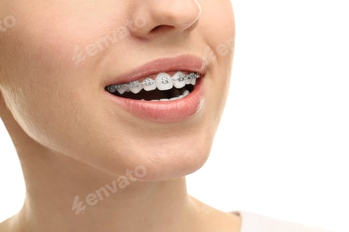 Preview: Smiling woman with dental braces on white background, closeup