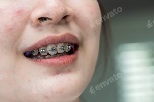 Preview: Braces in teenage girl mouth to treat and beauty for increase confidence and good personality.