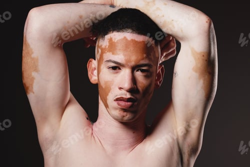 Preview: Skincare, beauty and portrait of man with vitiligo on black background for wellness, dermatology an