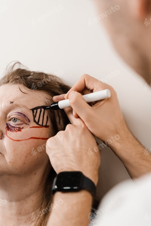 Preview: Brow lifting pre-op face markup Browpexy Suture fixes brow to bone securely