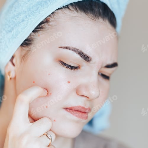 Preview: Pretty girl with towel on head squeezing pimple in towel on her head