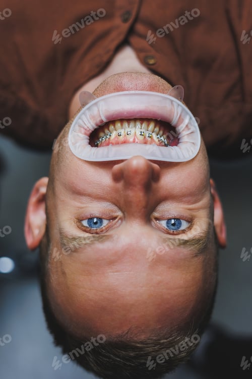 Preview: Dental treatment of teeth. A young man at a dentist's appointment. The doctor installs metal braces
