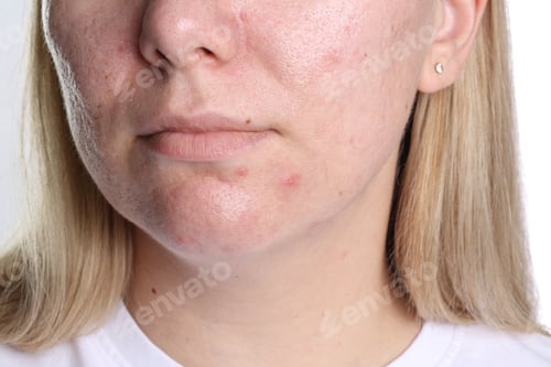 Preview: Woman with acne problem on white background, closeup