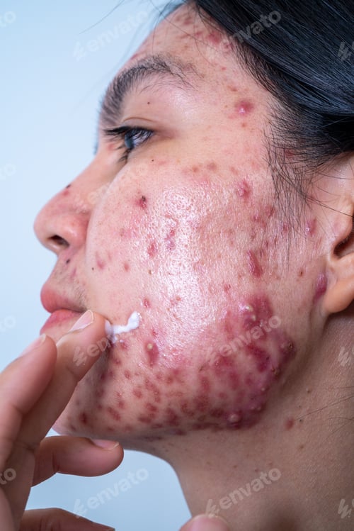 Preview: Acne on face because the disorders of sebaceous glands productions. Acne or a Cosmetic Allergy.
