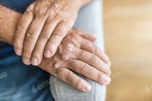 Preview: Elderly man suffering from psoriasis on hands