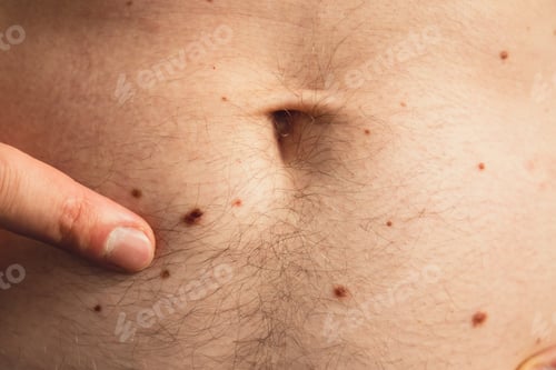 Preview: Unrecognizable man showing his birthmarks on skin Close up detail of the bare skin Sun Exposure
