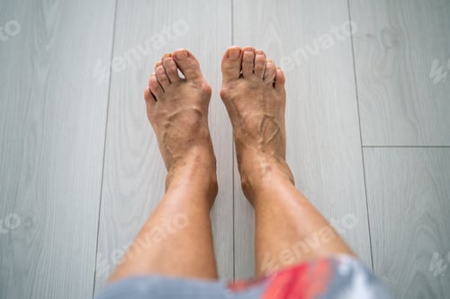 Preview: Senior woman varicose bare feet with valgus deformity. Activity pain, orthopaedics need, bunion