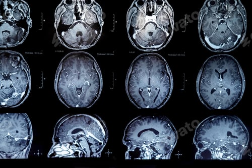 Preview: mri with brain tumor. Magnetic resonance imaging.