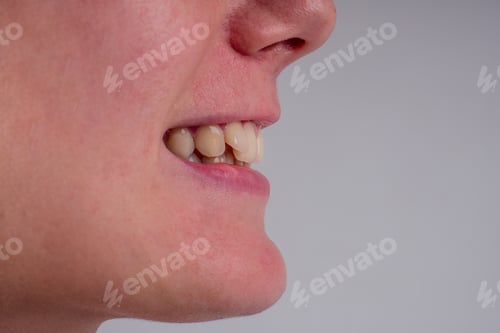 Preview: white smile with curvature tooth of young woman on background in studio