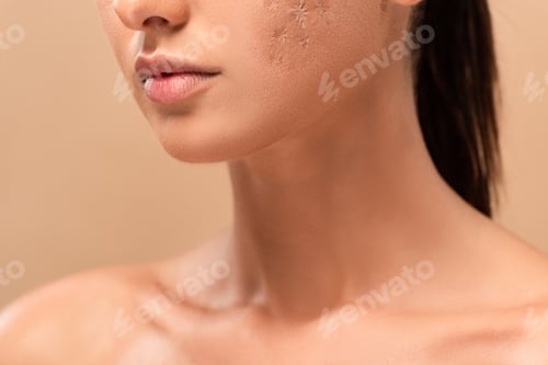 Preview: cropped view of young naked woman with blemished skin isolated on beige