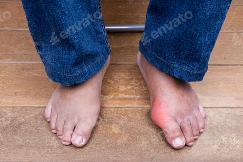 Preview: Man with swollen deformed inflammed toe joint with painful gout on wooden floor