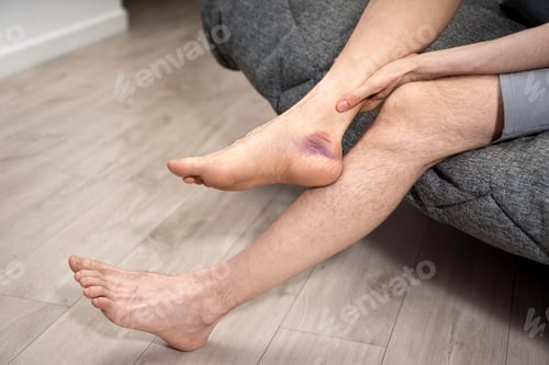 Preview: Man gently touches his leg with bruised ankle purple color from injury