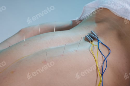 Preview: Electroacupuncture needles and electrodes on back for pain therapy