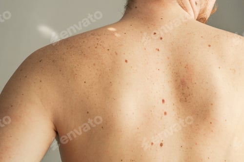 Preview: Skin on a man back with scattered moles