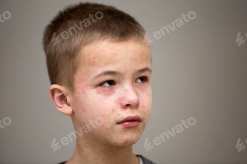 Preview: Portrait of sick sad boy child suffering from measles or chicken pox with bumps