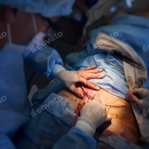 Preview: Male surgeon stitching up wound after abdominoplasty surgery.