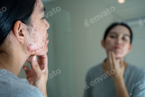Preview: Acne on face because the disorders of sebaceous glands productions. Acne or a Cosmetic Allergy.