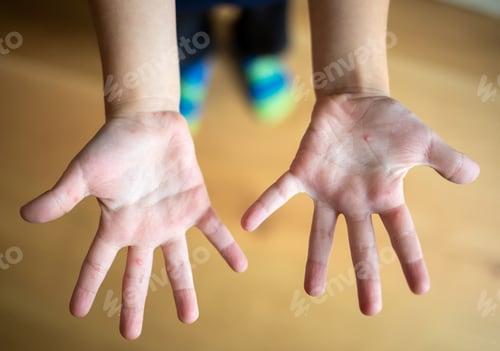 Preview: Child's hands showing symptoms of Hand Foot and Mouth disease