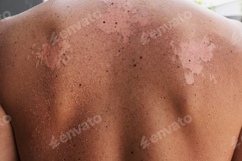 Preview: Close-up of a male back with peeling skin due to sunburn