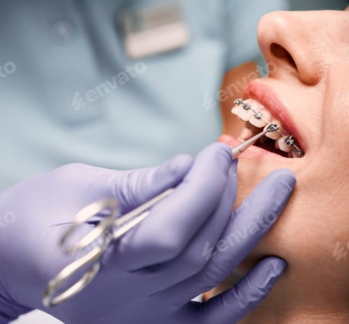 Preview: Orthodontist hands placing braces on woman teeth.