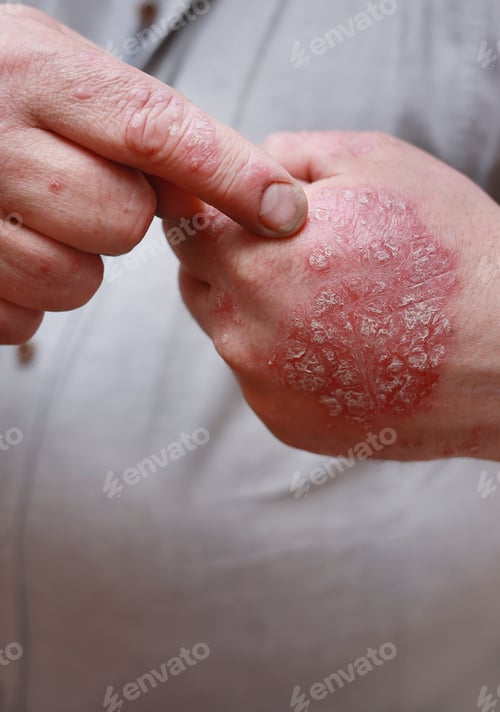 Preview: Close up of male showing hands with cracked, hard, horny, flaky skin. Dermatological problems of