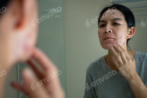 Preview: Acne on face because the disorders of sebaceous glands productions. Acne or a Cosmetic Allergy.