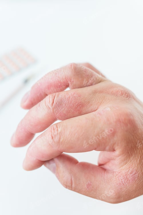 Preview: The causes of itchy skin can be dermatitis (eczema), dry skin, burns, food allergies. healthcare