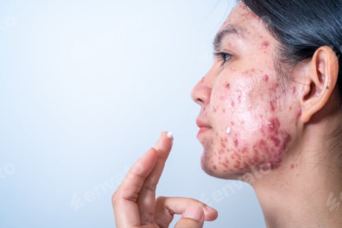 Preview: Acne on face because the disorders of sebaceous glands productions. Acne or a Cosmetic Allergy.