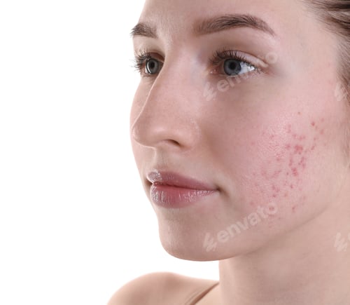 Preview: Young woman with acne problem on white background, closeup