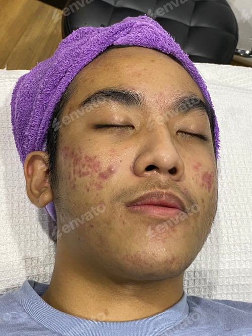 Preview: Acne problems