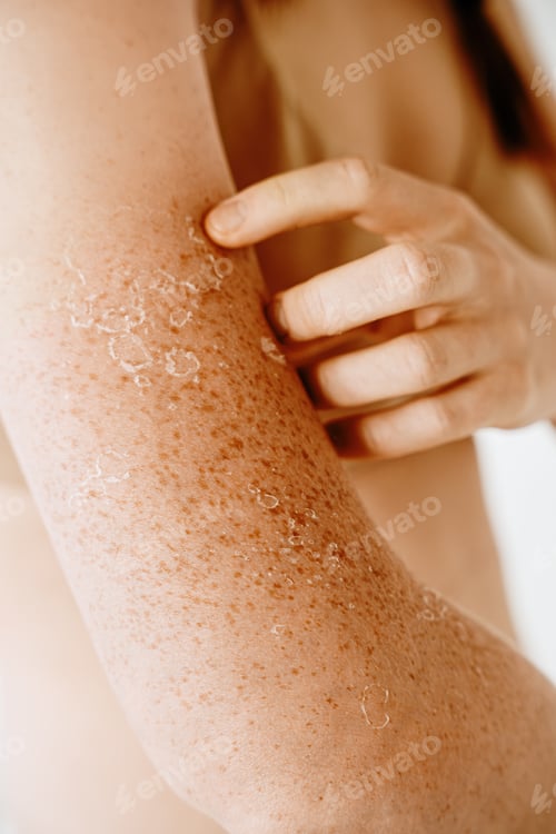 Preview: Peeling skin after sunburn, dermatology problems