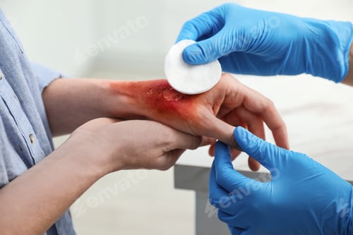 Preview: Doctor covering patient's burn of hand with cotton pad indoors, closeup