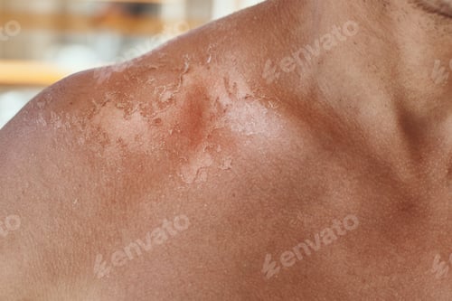 Preview: Sunburn on the shoulders of men. Shoulders with a hurt skin fron sun burn, closeup