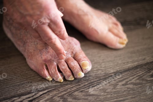 Preview: Elderly person applying cream to fungal foot infection