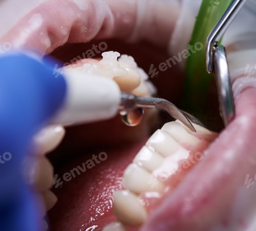 Preview: Doctor doing professional teeth cleaning in dental clinic
